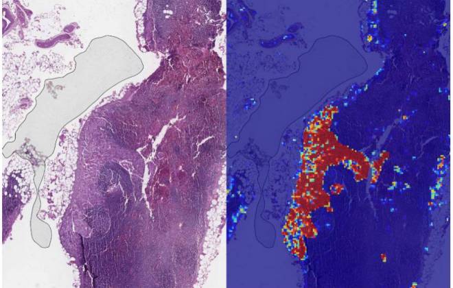 Inteligência artificial do Google detecta câncer de mama com 99% de precisão